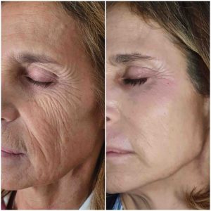 Foto antes y después Plexr pro medicina estética madrid medicina estética chamberí medico estético madrid