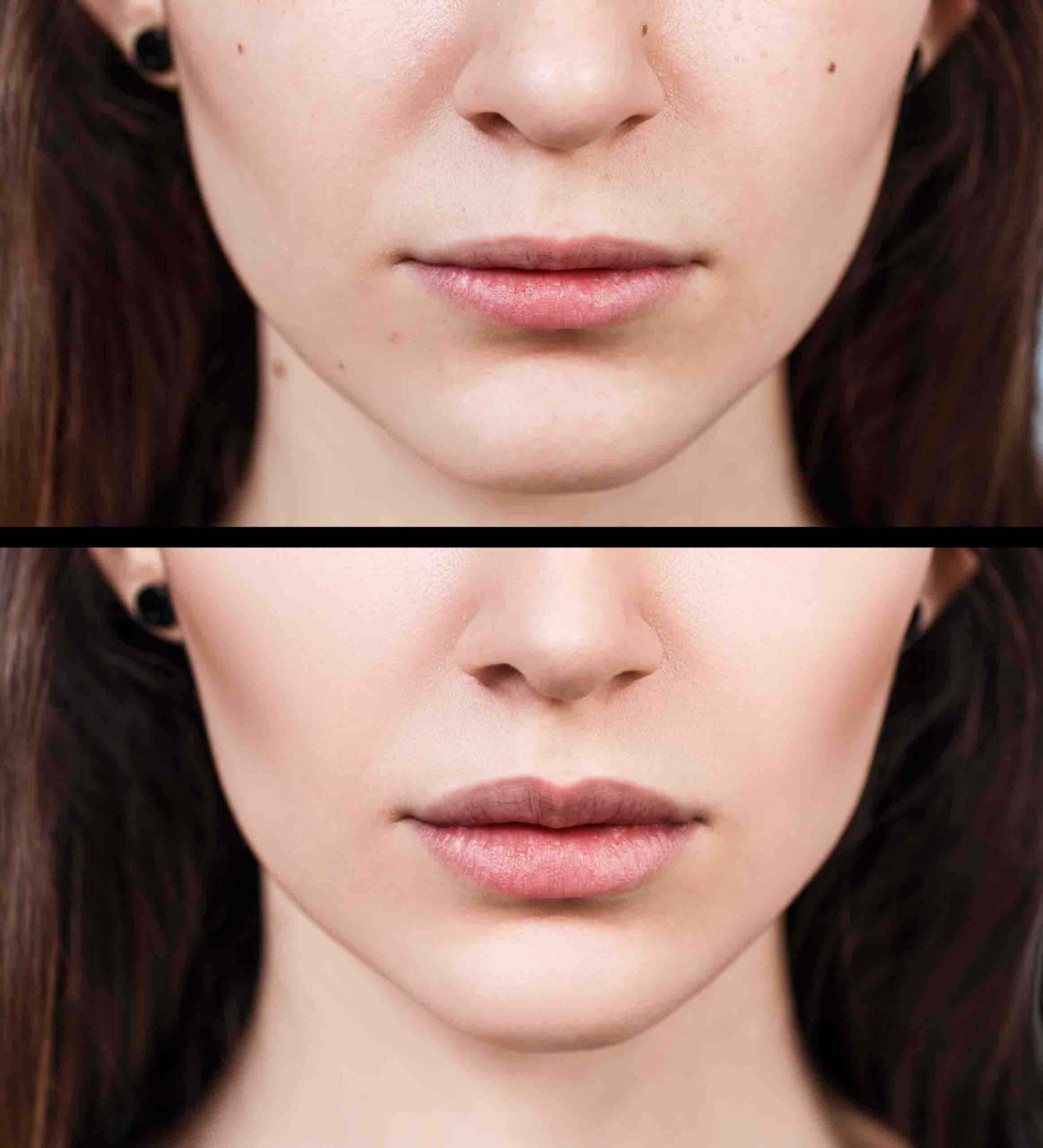 aumento de labios madrid antes y después