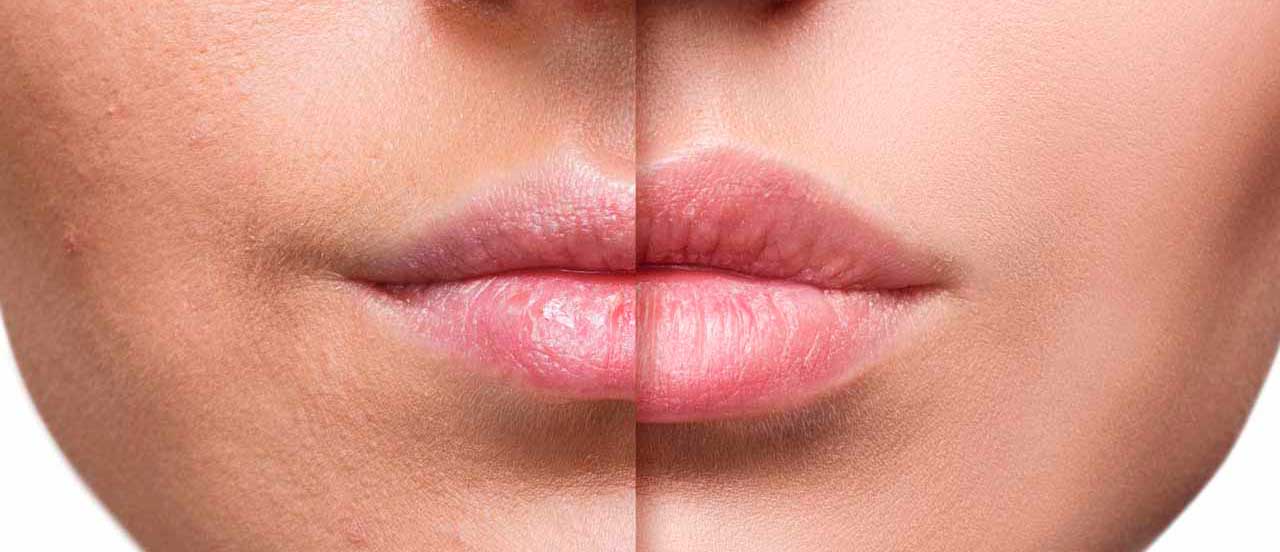 10 cosas sobre aumento de labios