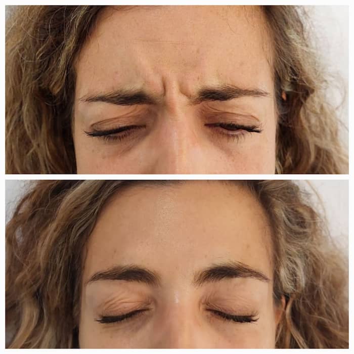 Botox en Entrecejo, Antes y Después