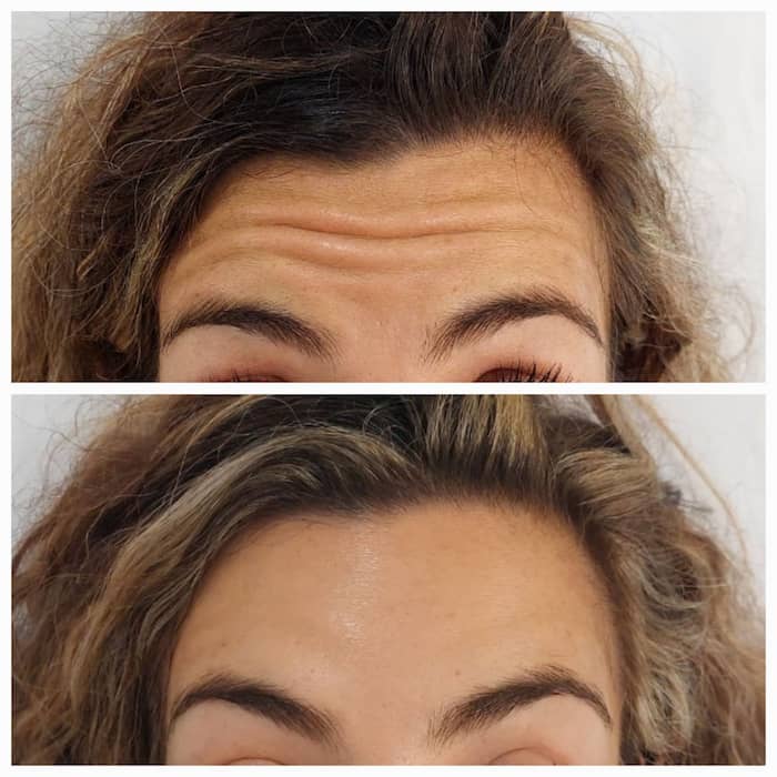 Botox frente antes y después