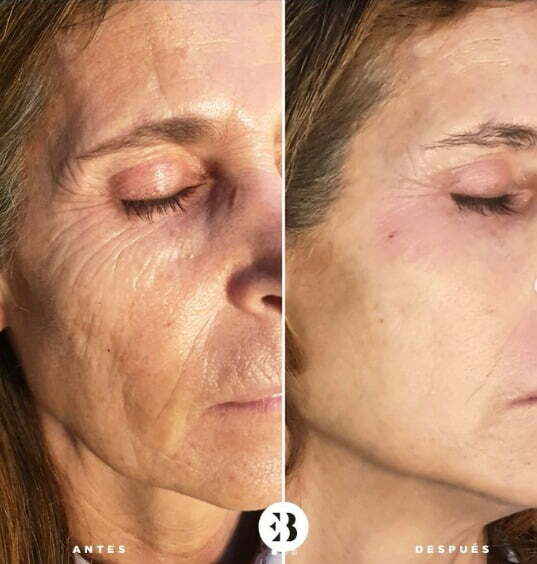 Tratamiento Rejuvenecimiento Facial con PlexR Pro