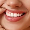 botox sonrisa gingival madrid
