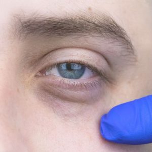 Quitar Ojeras hundidas