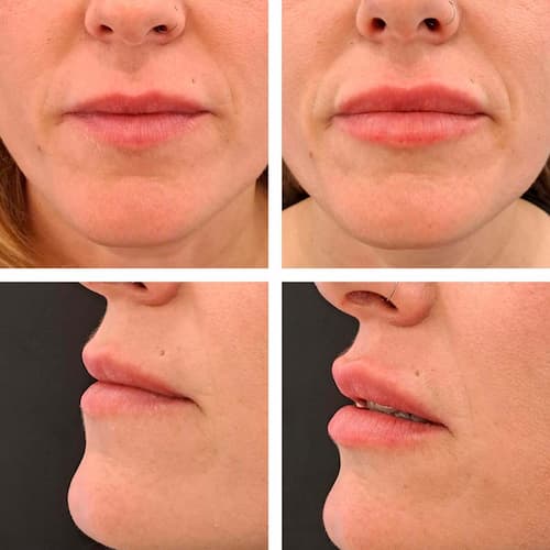 aumento de labios antes y después