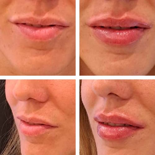 antes y después tratamiento aumento de labios