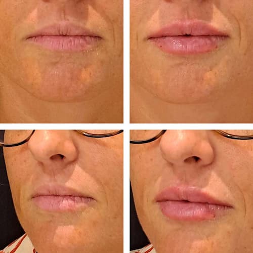 antes y después tratamiento aumento de labios