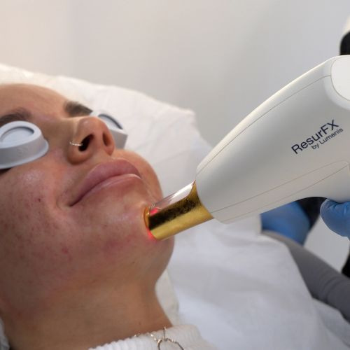 Tratamiento laser Lumenis M22 en Madrid en la Clínica de Medicina Estética Dra Elena Berezo
