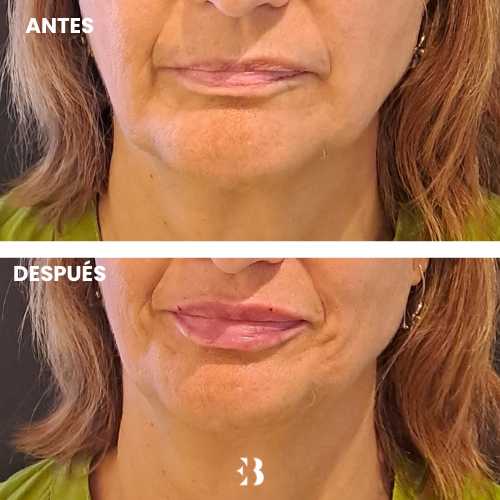 Antes y después del tratamiento de ácido hialurónico para los labios en la clínica de medicina estética Dra Elena Berezo