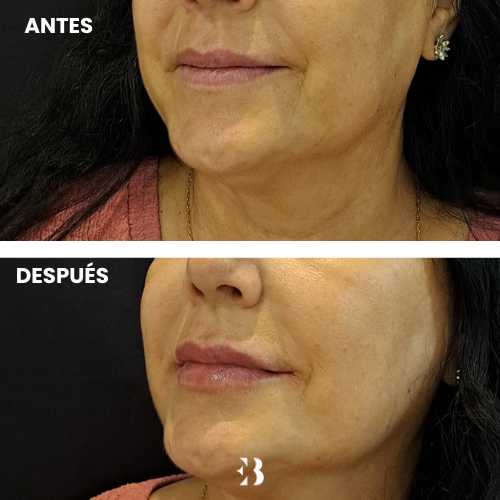Antes y después del tratamiento de ácido hialurónico para los labios en la clínica de medicina estética Dra Elena Berezo