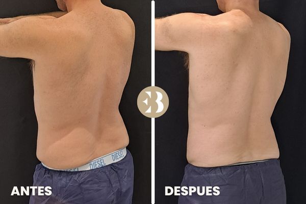 antes y después criolipolisis cintura