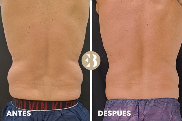 antes y después coolsculpting cintura