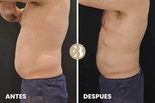 antes y después criolipolisis cintura