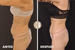 antes y después coolsculpting abdomen