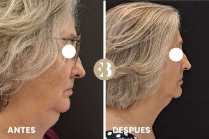 antes y después coolsculpting papada
