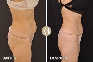 antes y después criolipolisis abdomen