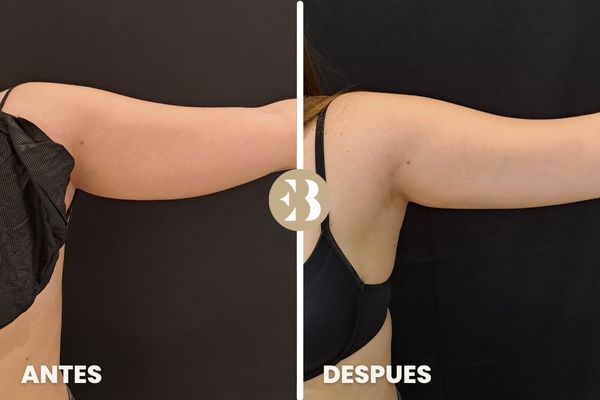 antes y después criolipolisis brazos