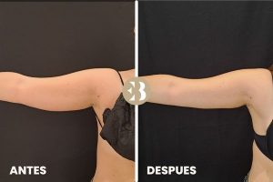 antes y después coolsculpting brazos