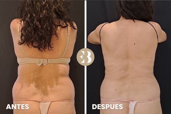 antes y después criolipolisis espalda