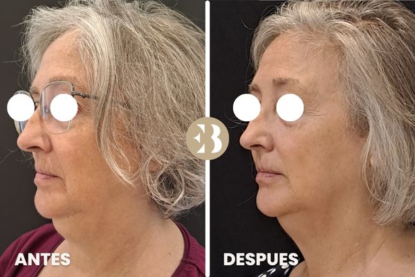 antes y después coolsculpting papada