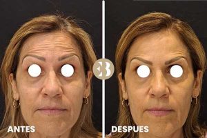 Antes y Después tratamiento eliminar arrugas en frente con Neuromodulador, Toxina Botulínica, Botox