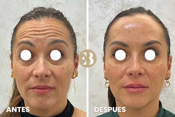 Antes y Después tratamiento de reducir arrugas en frente con Neuromodulador, Toxina Botulínica, Botox