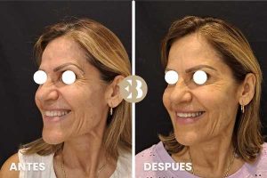 Antes y Después tratamiento para eliminar arrugas en patas de gallo con Neuromodulador, Toxina Botulínica, Botox