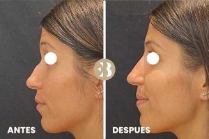 Tratamiento rinomodelación Madrid Antes y después en la clínica de medicina estetica EB
