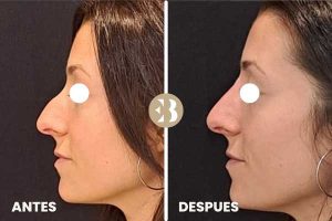 Antes y después tratamiento rinomodelacion en la clínica de medicina estetica EB