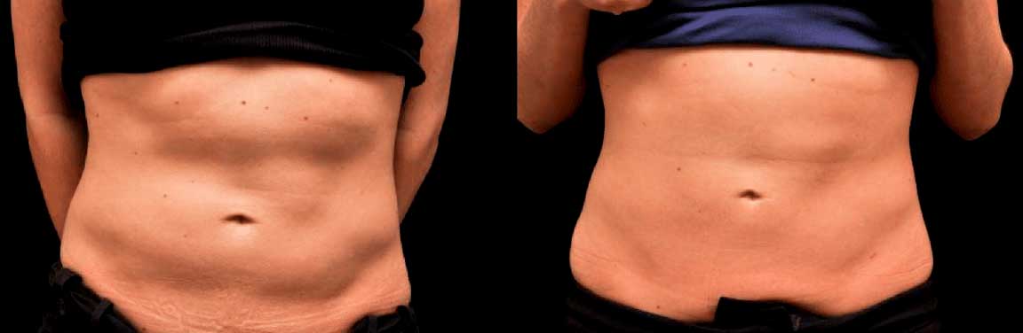 eliminar grasa abdomen mujer