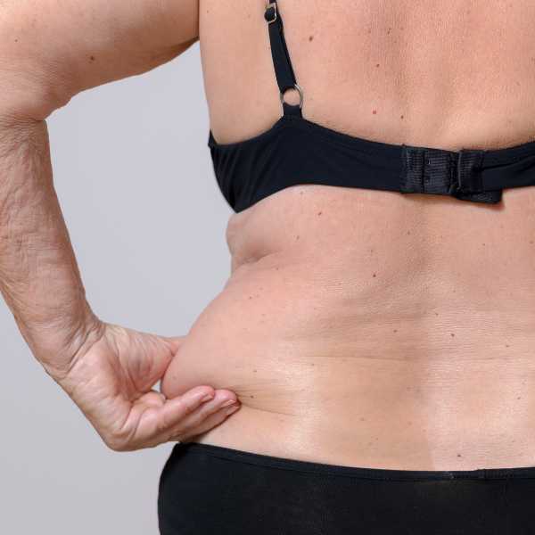 Tratamiento para eliminar la grasa de la espalda en la clínica de medicina estética de la dra Elena Berezo