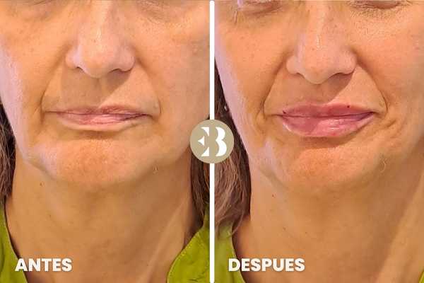 antes y después del aumento de labios