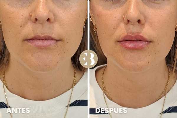antes y después hidratación labios