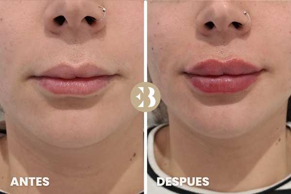 antes y después aumento e hidratación labios