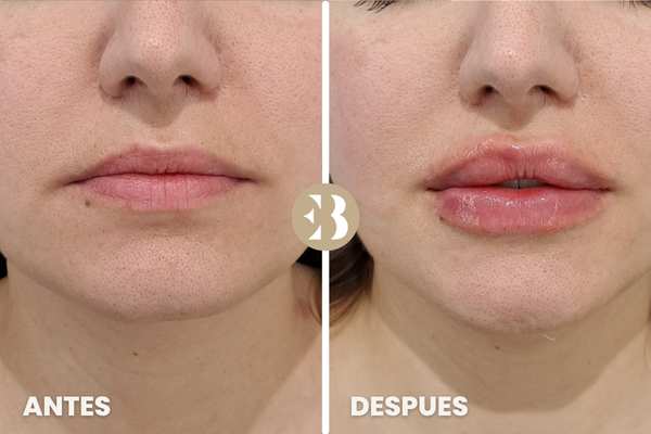 antes y después hidratación y perfilado de los labios