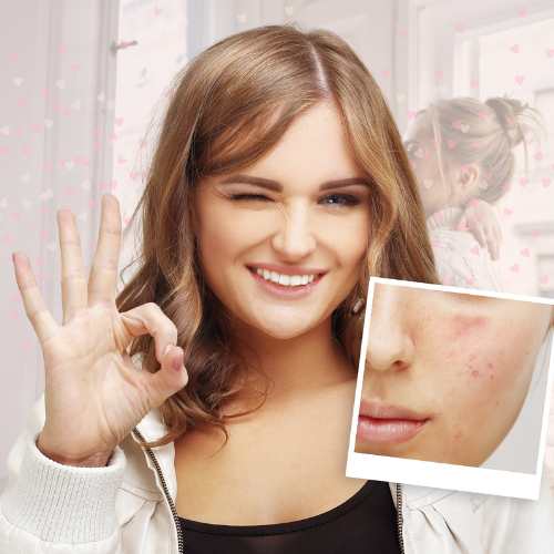 Promoción eliminar acne, estrias y cicatrices en la Clínica de Medicina Estética en Madrid de la Dra Elena Berezo