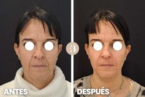 surco nasogeniano antes y después