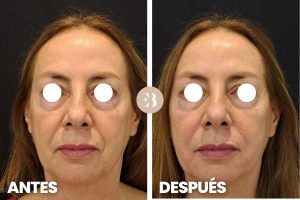 antes y después surco nasogeniano eliminar