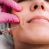 Precio tratamiento surco nasogeniano en clinica de medicina estética IME