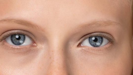 antes y después acido hialuronico en ojeras