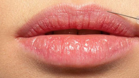 aumento labios con acido hialuronico