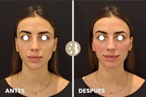 Aumento de pómulos antes y después en la Clinica de Medicina Estética EB en Madrid