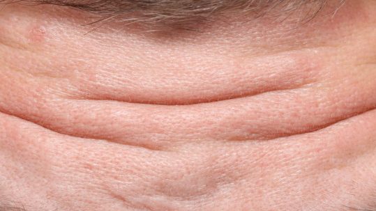 eliminar arrugas mejores tratamientos medicos estéticos