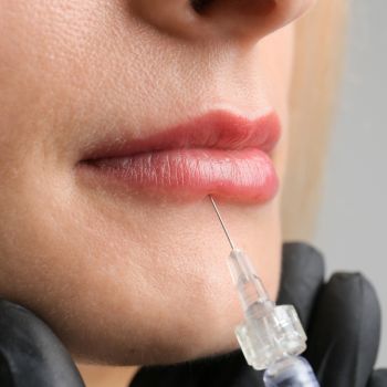 perfilado y relleno de labios en la clinica de medicina estetica EB en Madrid perfilado y relleno de labios en la clinica de medicina estetica EB en Madrid