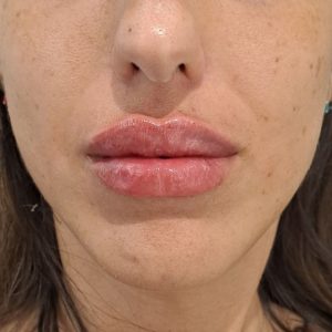 aumento de labios después aumento de labios después