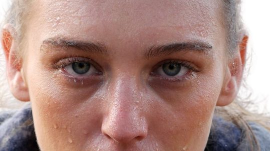 hiperhidrosis facial tratamiento con botox