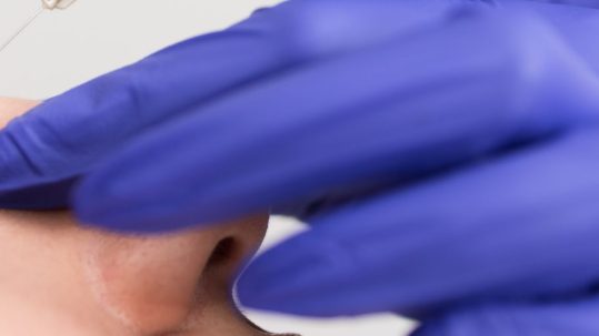 rinomodelacion con acido hialuronico-madrid en la Clinica de medicina Estetica EB