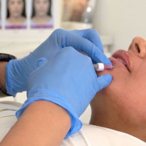 acido hialurónico labios cuidados tras inyectarse acido hialuronico labios