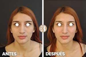 aumento de pómulos antes y después