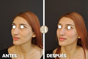 aumento de pómulos antes y después